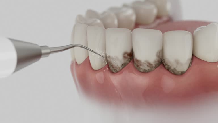 Trusted Dental Veneers service in Sullivan's Island, SC - Dentist Open Now